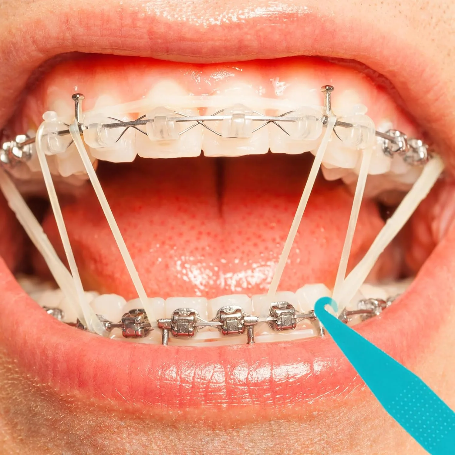 Elastic Bands Placers for Braces - 100 Pack - Image 5