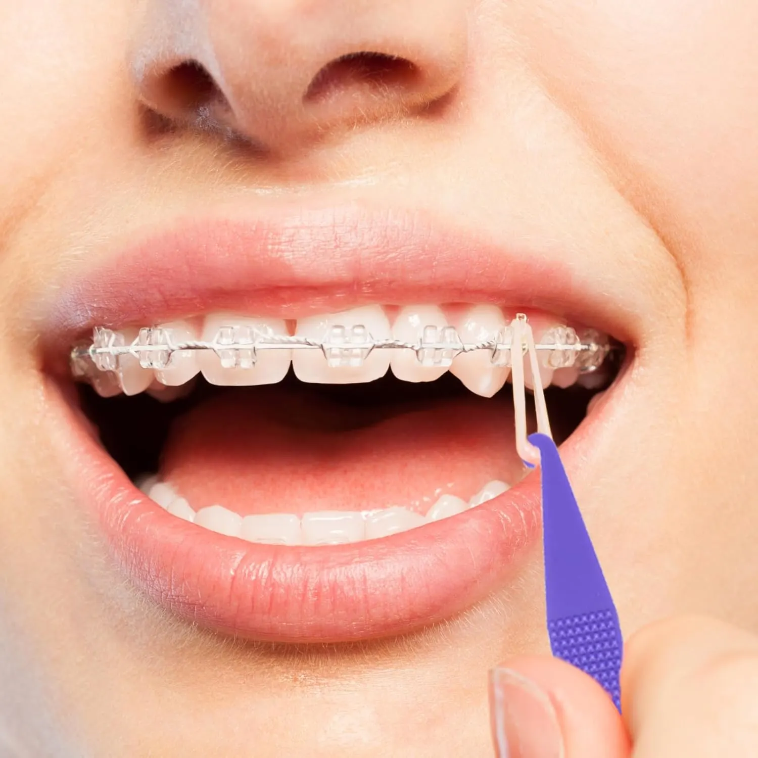 Elastic Bands Placers for Braces - 30 Pcs - Image 6