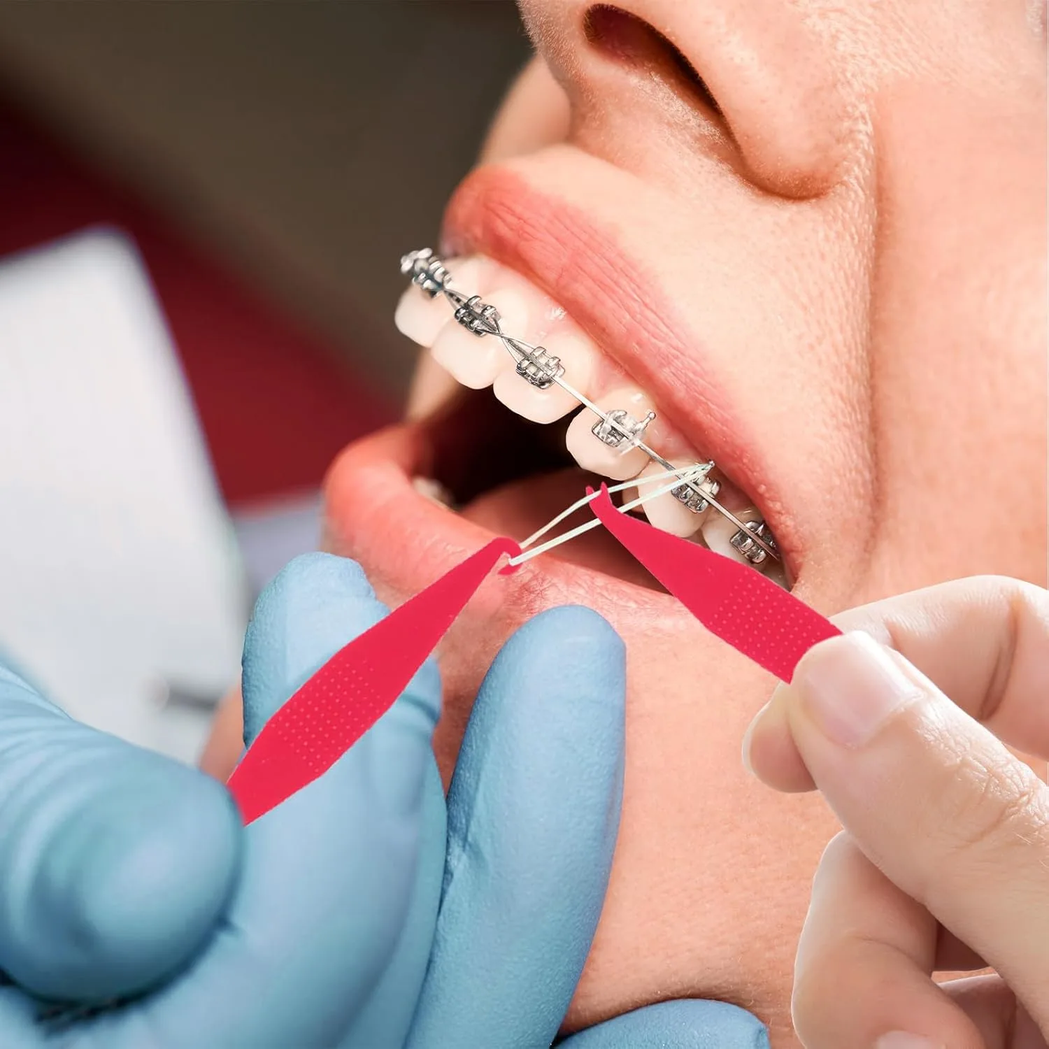 Elastic Bands Placers for Braces - 30 Pcs - Image 7