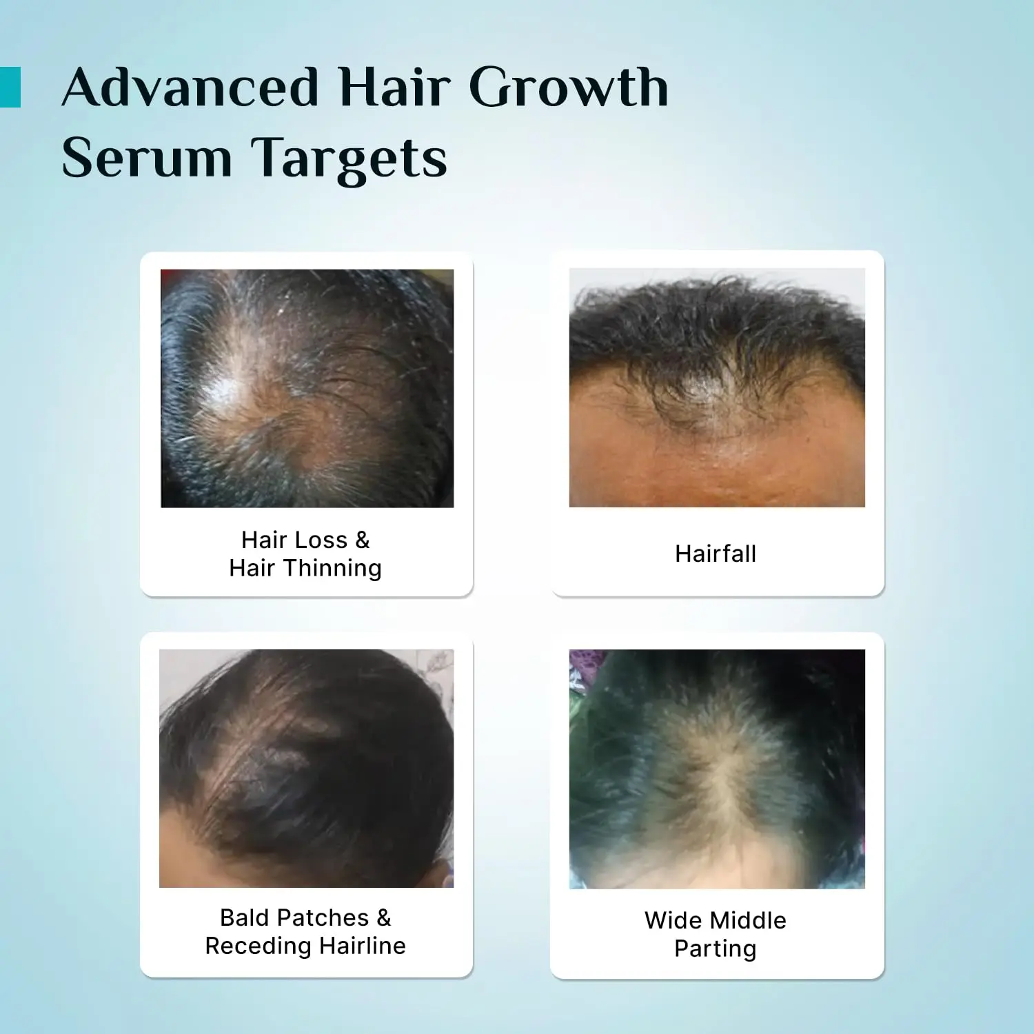 Pilgrim Redensyl hair growth serum with Anagain and Baicapil promotes thicker, denser, and stronger hair for all hair types, addressing thinning and stimulating regrowth.