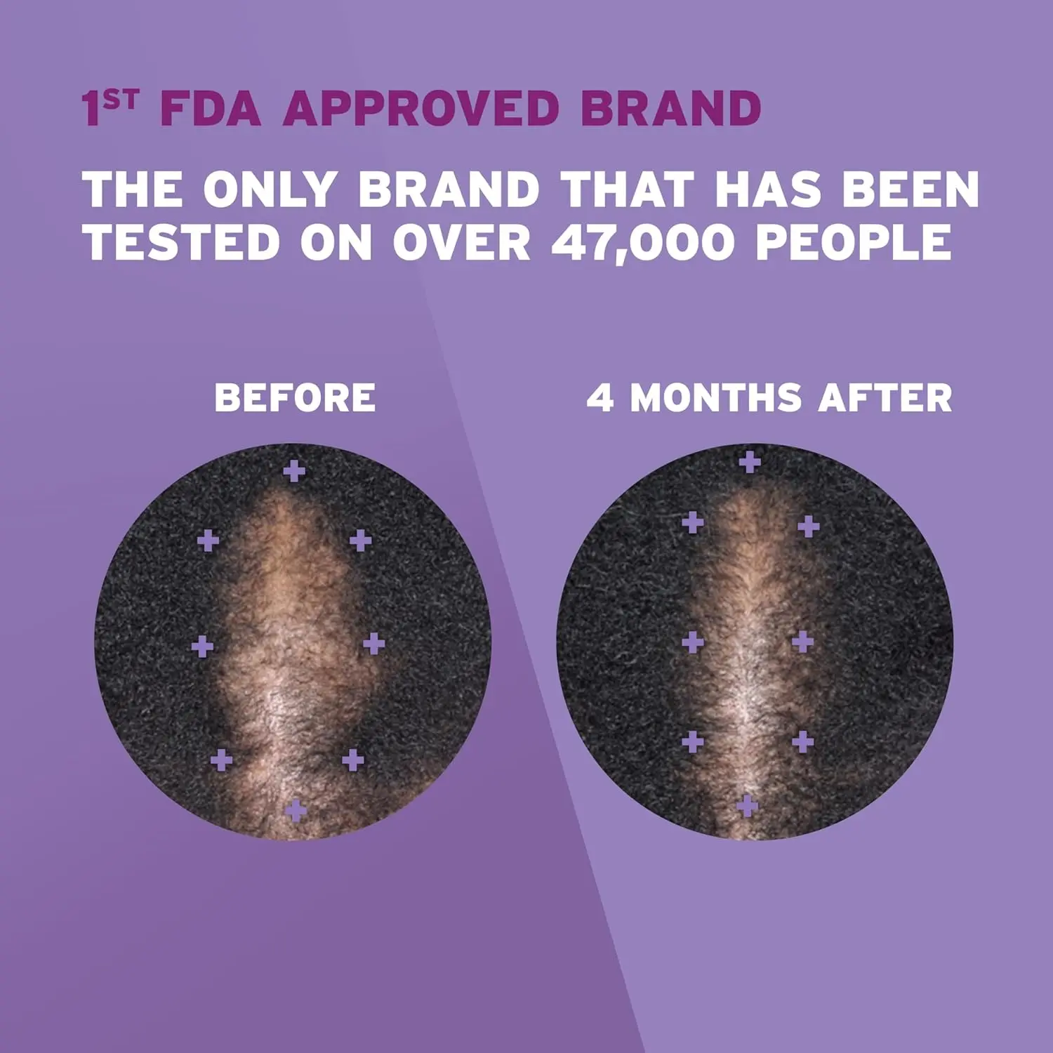 This image shows Rogaine Women's 5% Minoxidil Foam, a once-a-day topical treatment that helps women regrow fuller, thicker hair and combat hair loss.