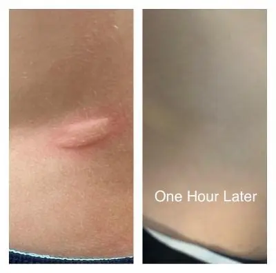 SIANI probiotic spray made with organic ingredients providing relief from skin irritations, acne, eczema, and more for kids and teens.