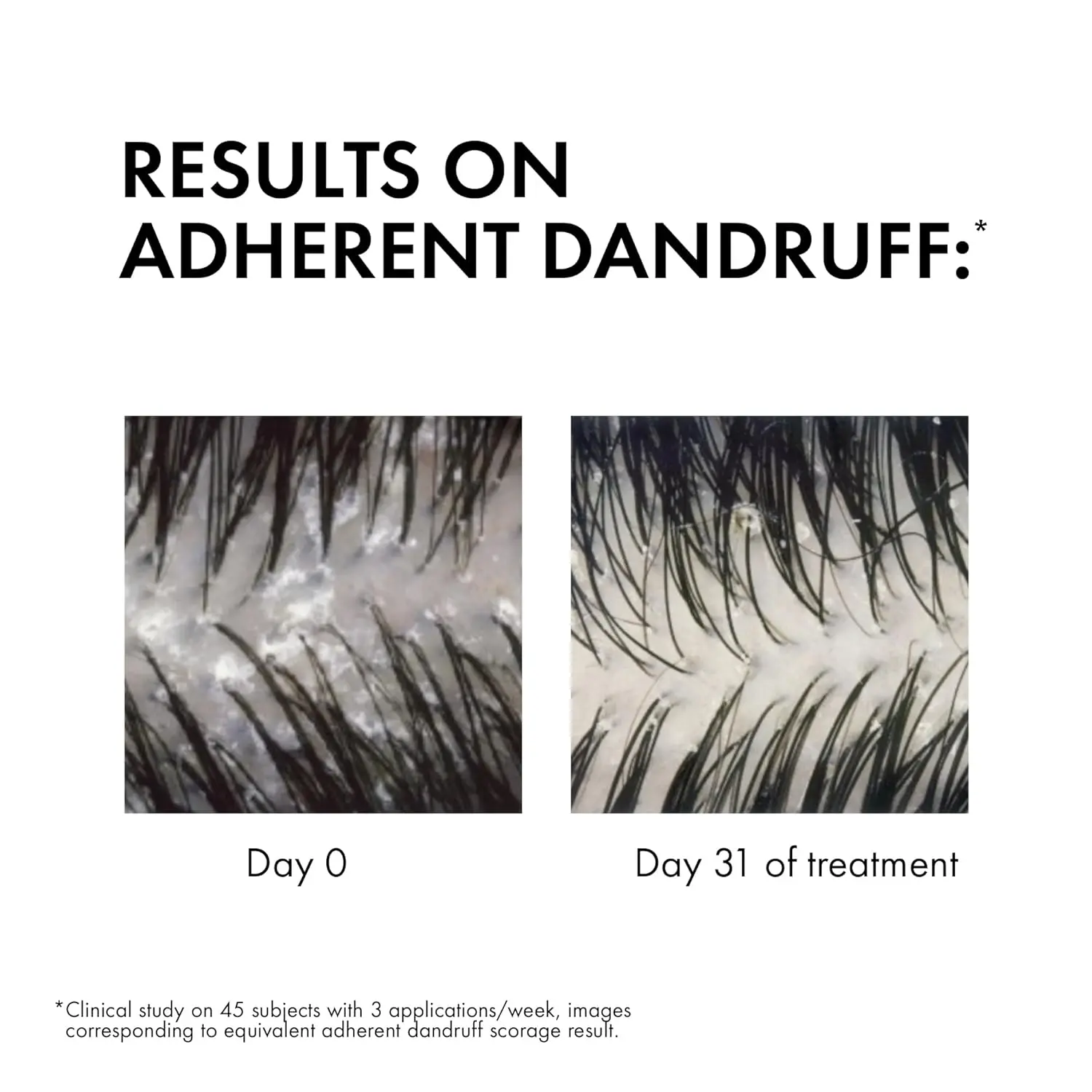 Vichy Dercos anti-dandruff shampoo for oily hair, eliminating visible flakes, intensely soothing itch, and preventing recurrence.