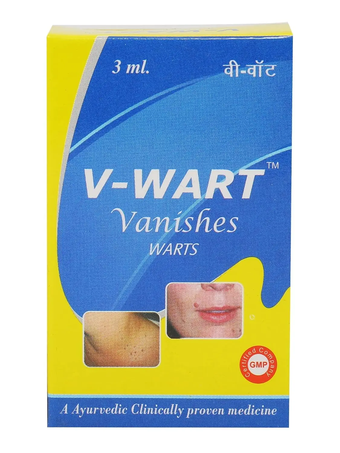 Three bottles of VWART wart and corn remover liquid with wooden applicator for effective and painless treatment of common and plantar warts.