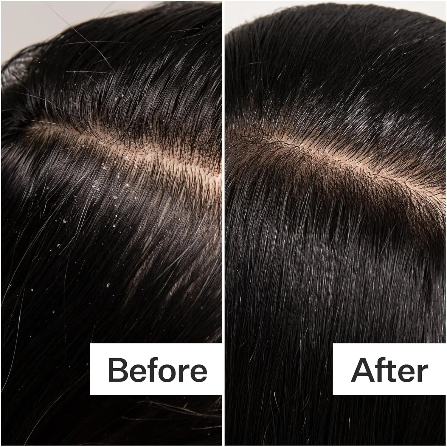 ACT+ACRE scalp detox for removing buildup and nourishing hair follicles.