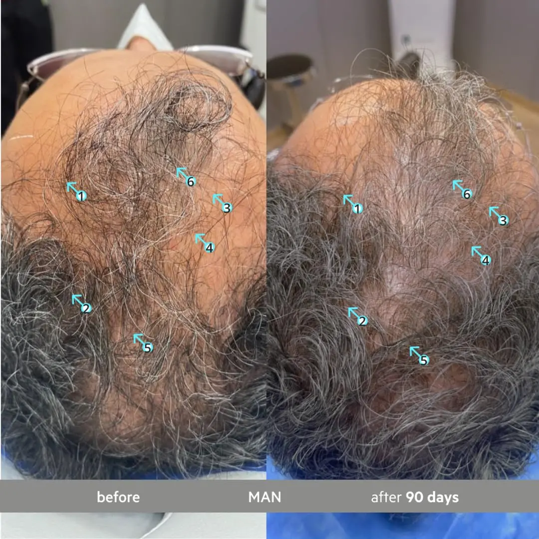 DS Laboratories Spectral.DNC-S anti-gray hair serum promotes hair growth and restores color for fuller, thicker hair in men and women.