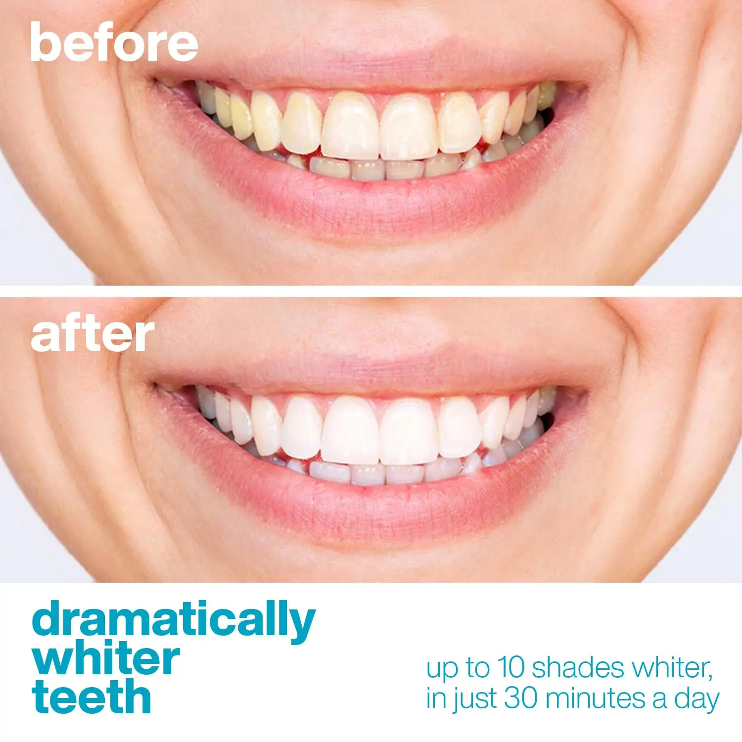 AquaSonic teeth whitening strips provide a fast, easy, and affordable way to achieve a whiter, brighter smile at home with dentist-quality results in just 7 days.