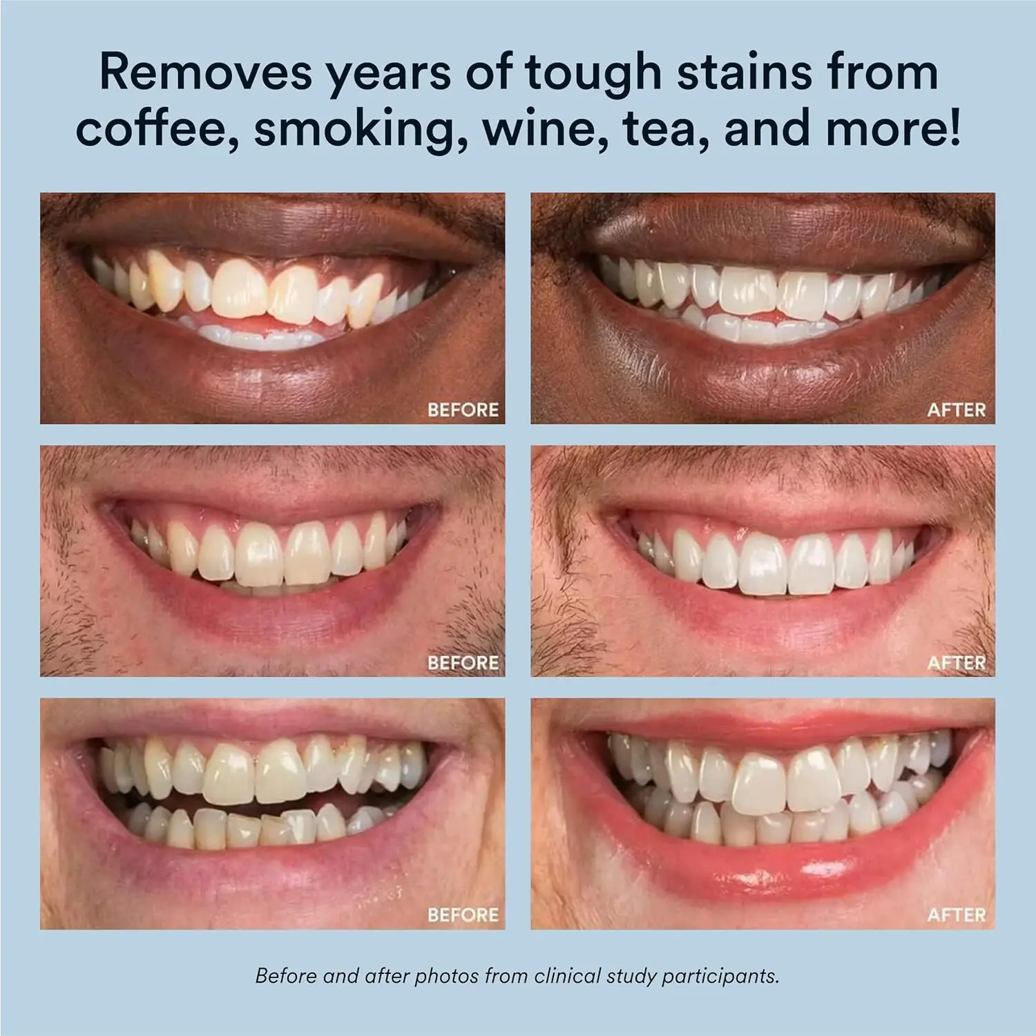 AuraGlow teeth whitener kit with LED light and two 5ml 35% carbamide peroxide gel syringes.