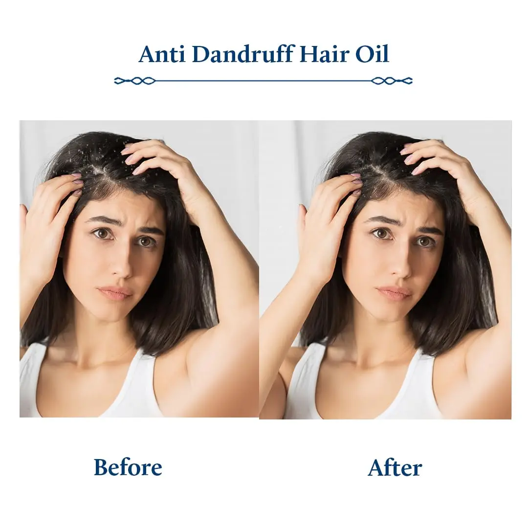Blue Nectar anti-dandruff hair oil with tea tree and neem helps relieve itchy, dry scalp and reduces dandruff for men and women.