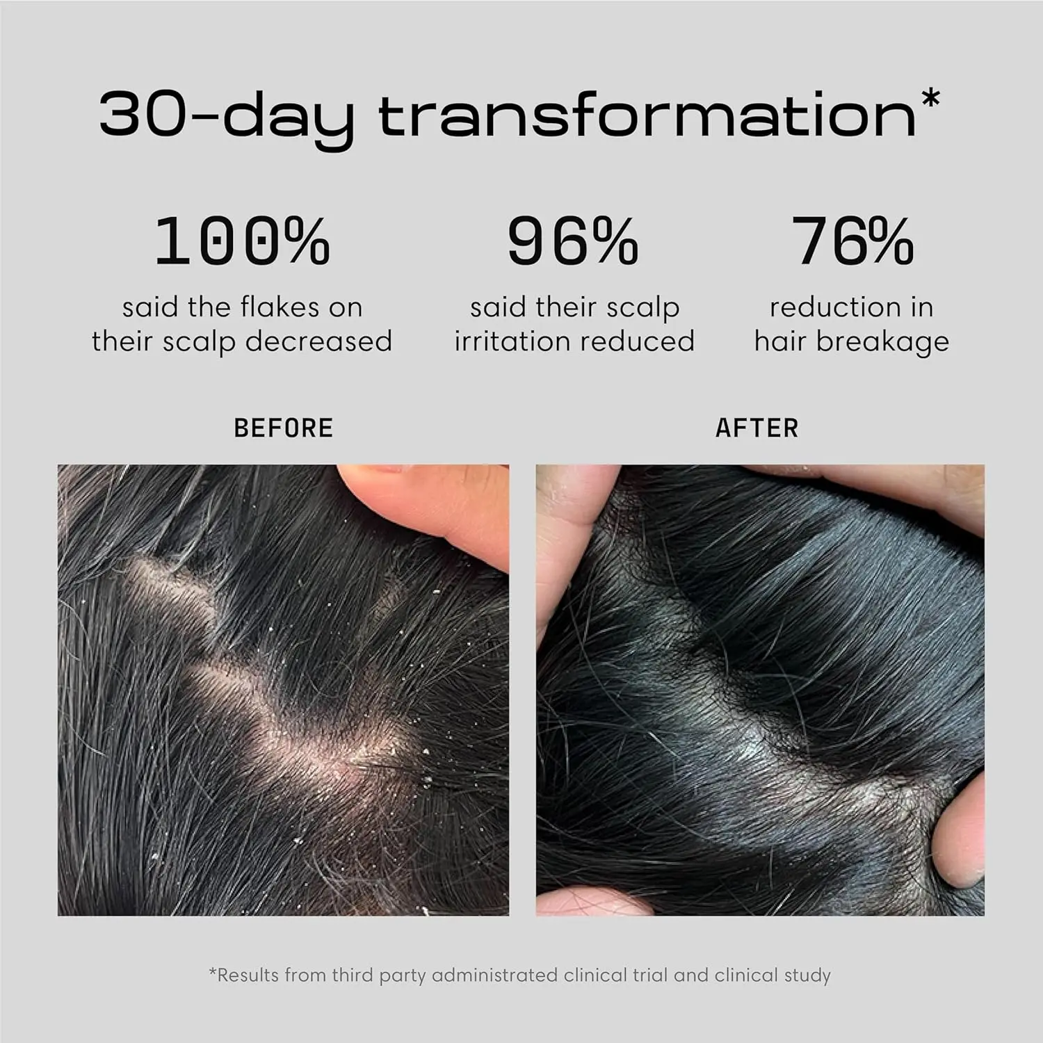 Jupiter anti-dandruff scalp serum with zinc pyrithione, salicylic acid, aloe vera, and green tea relieves itching, flaking, and irritation for oily and dry scalps.