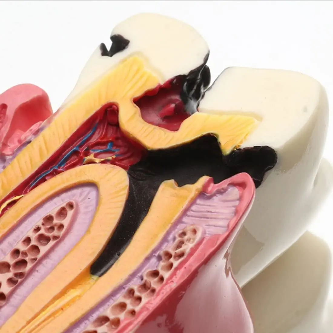 Six times enlarged dental caries tooth model used for study, comparison and patient education, showing tooth decay and its effects.