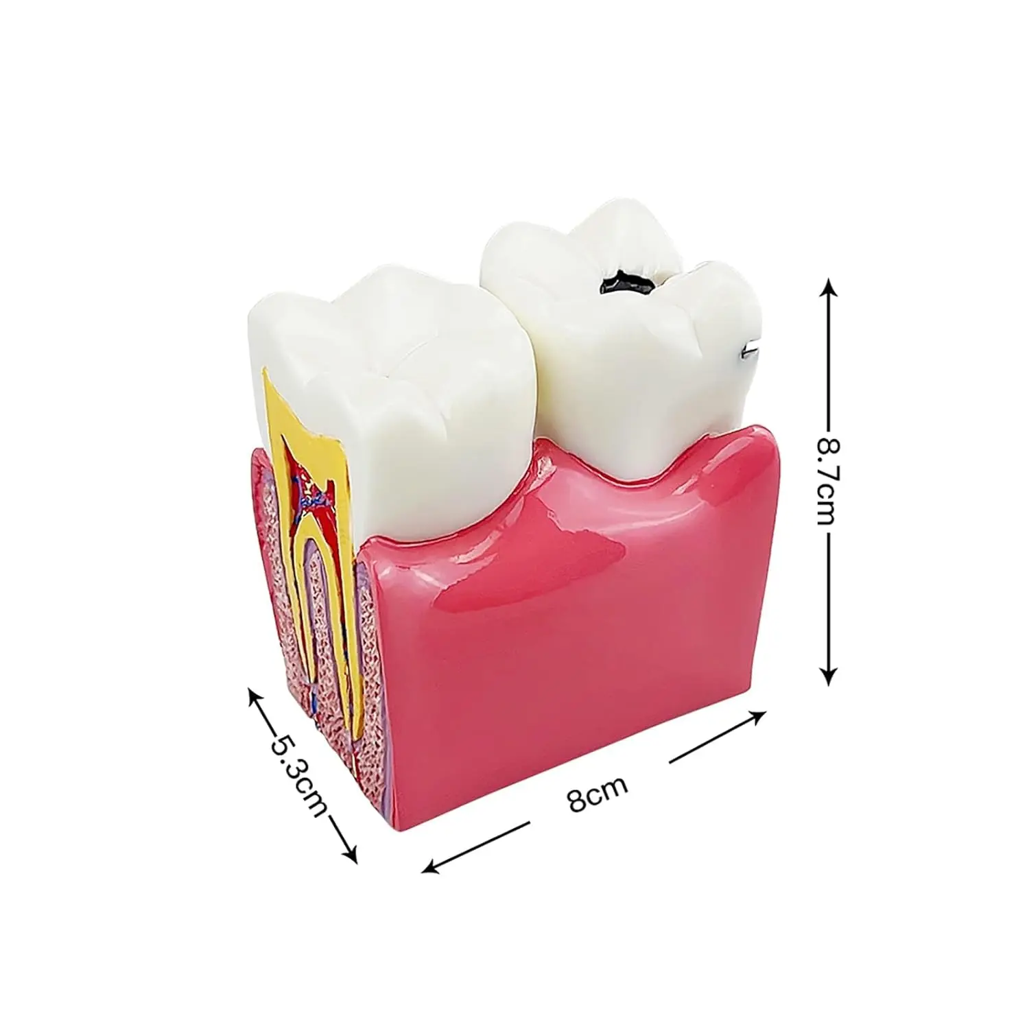 Six times enlarged dental caries tooth model used for study, comparison and patient education, showing tooth decay and its effects.
