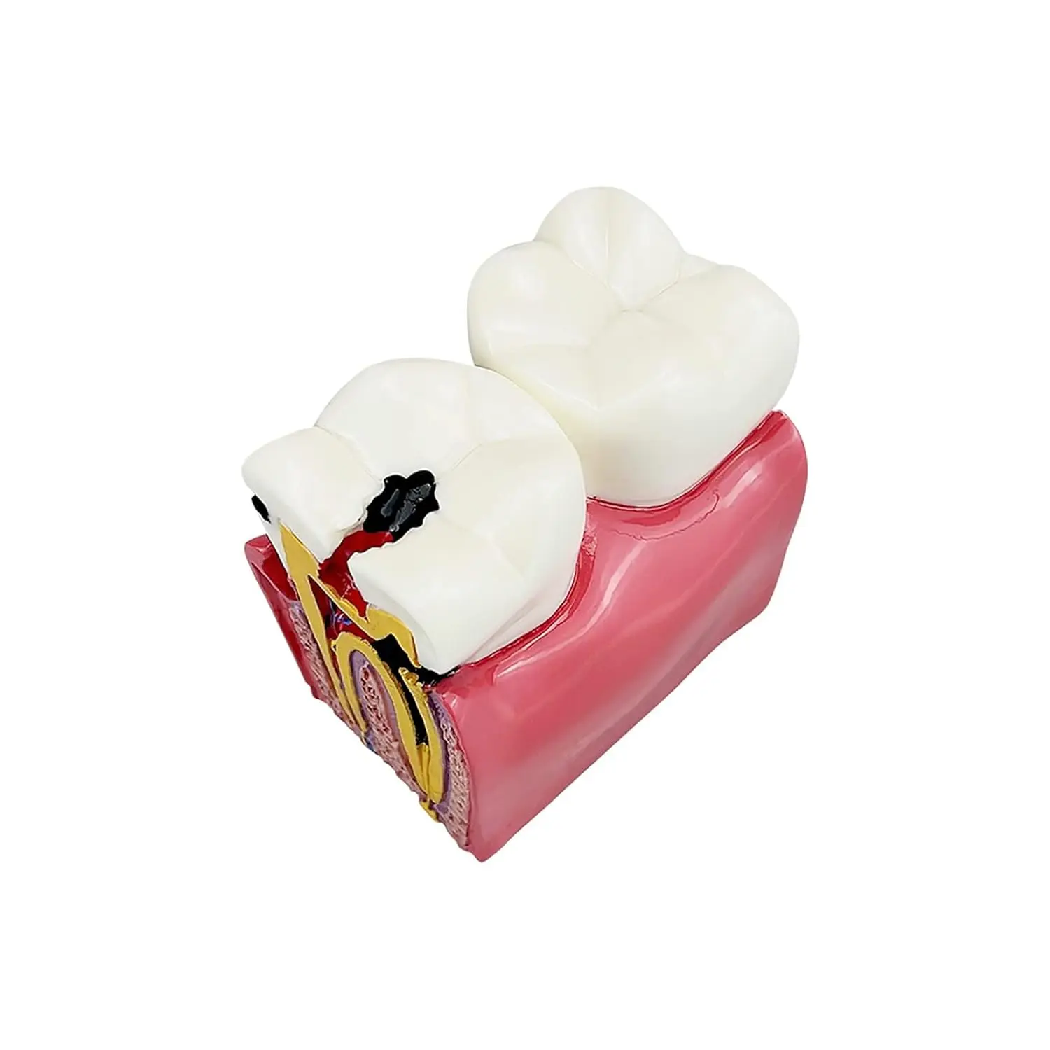 Six times enlarged dental caries tooth model used for study, comparison and patient education, showing tooth decay and its effects.
