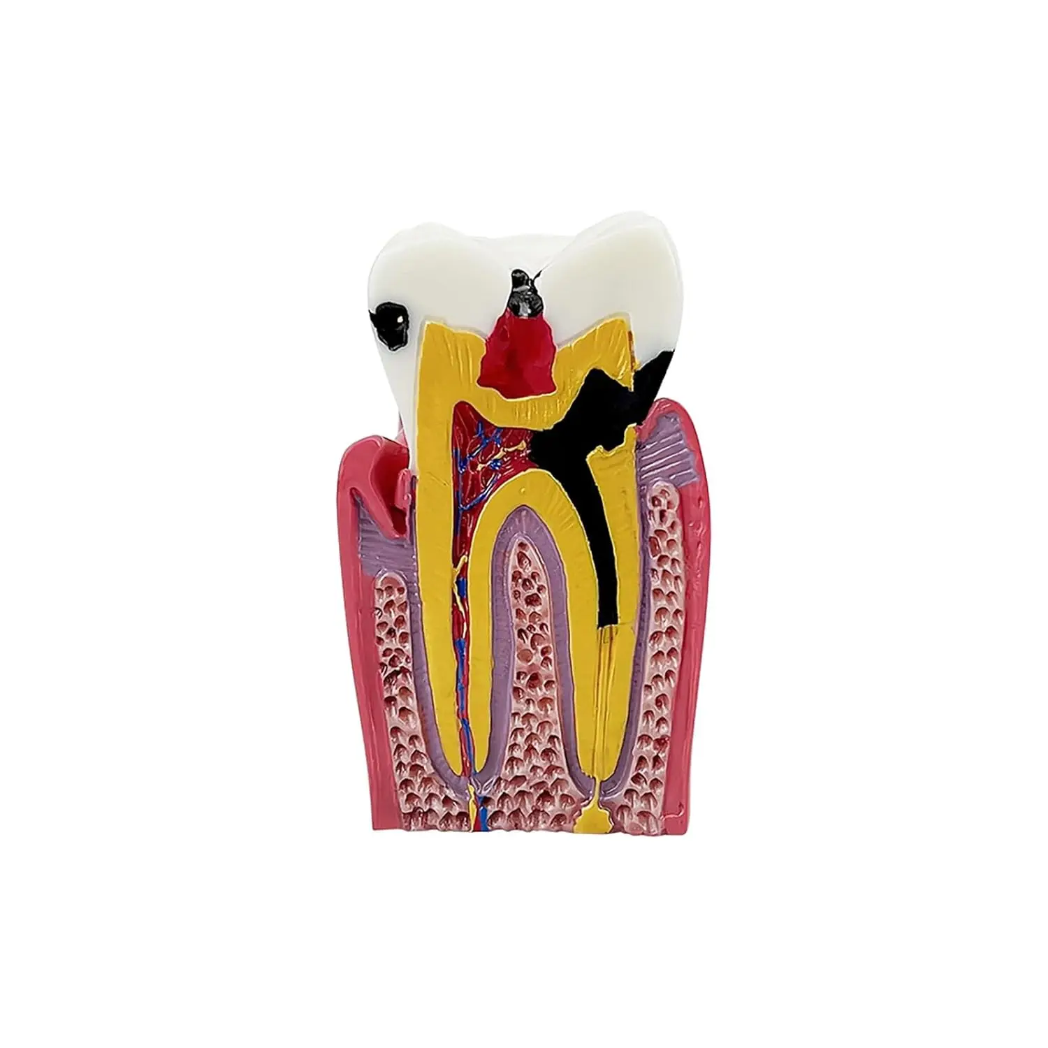 Six times enlarged dental caries tooth model used for study, comparison and patient education, showing tooth decay and its effects.