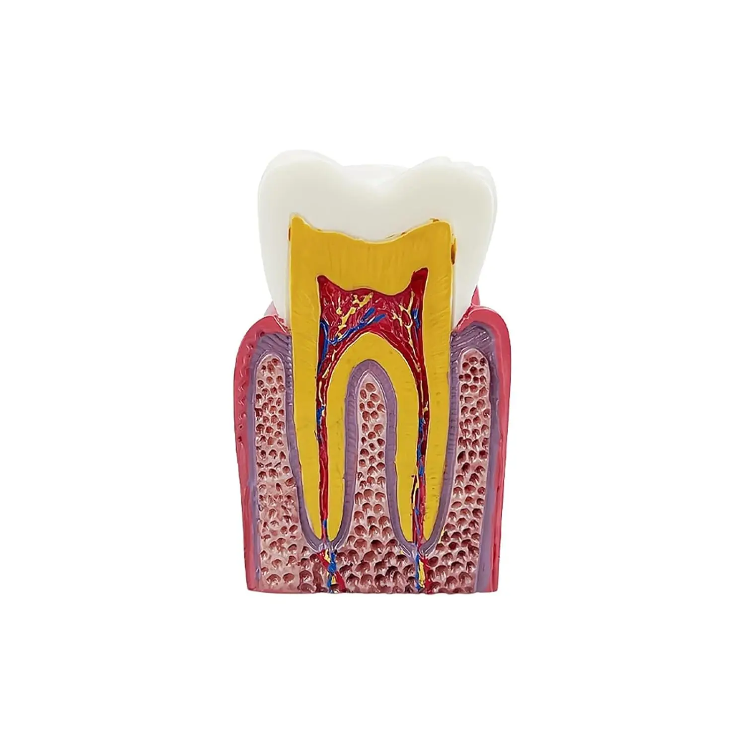Six times enlarged dental caries tooth model used for study, comparison and patient education, showing tooth decay and its effects.