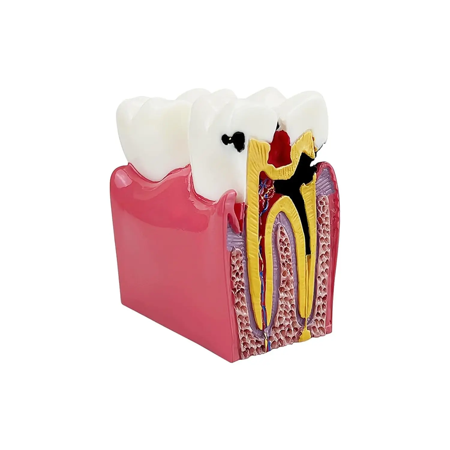 Six times enlarged dental caries tooth model used for study, comparison and patient education, showing tooth decay and its effects.