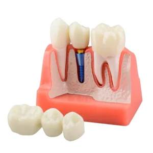 This 4X dental implant model with removable crown and bridge is ideal for patient education and demonstrates dental restoration options.