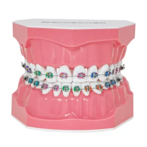 This dental orthodontic model demonstrates teeth with braces, wires, and elastics, ideal for teaching and explaining orthodontic concepts.