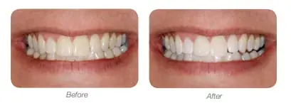 Two syringes of LumiSmile White 16% carbamide peroxide take-home teeth whitening treatment for a brighter, whiter smile with minimal sensitivity.