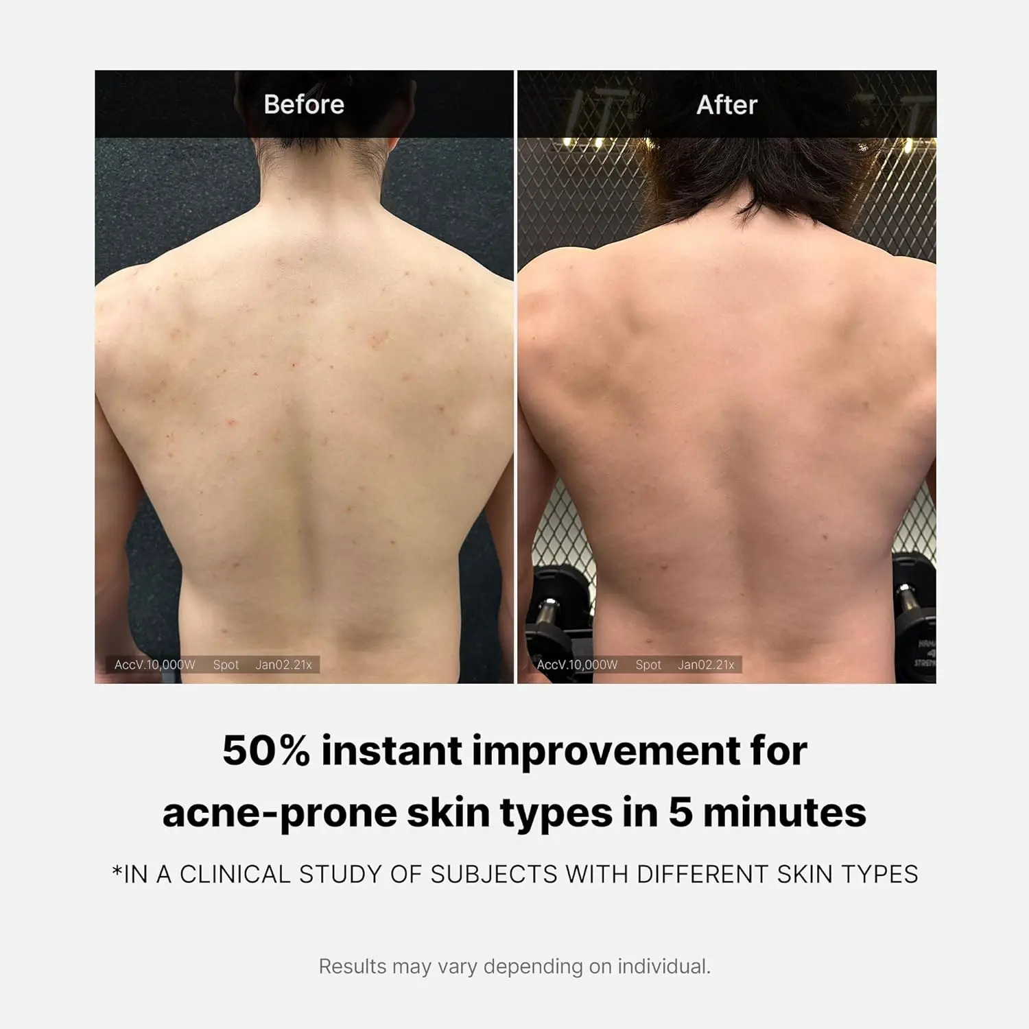 medicube Red Acne Body Wash with salicylic acid and niacinamide gently exfoliates and hydrates acne-prone skin, clinically tested for sensitive skin with a natural scent.