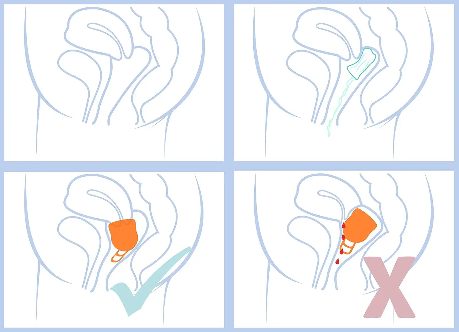 Orange Merula Cup XL menstrual cup for heavy flow, made in Germany from medical-grade silicone, a reusable and eco-friendly alternative to tampons and pads.