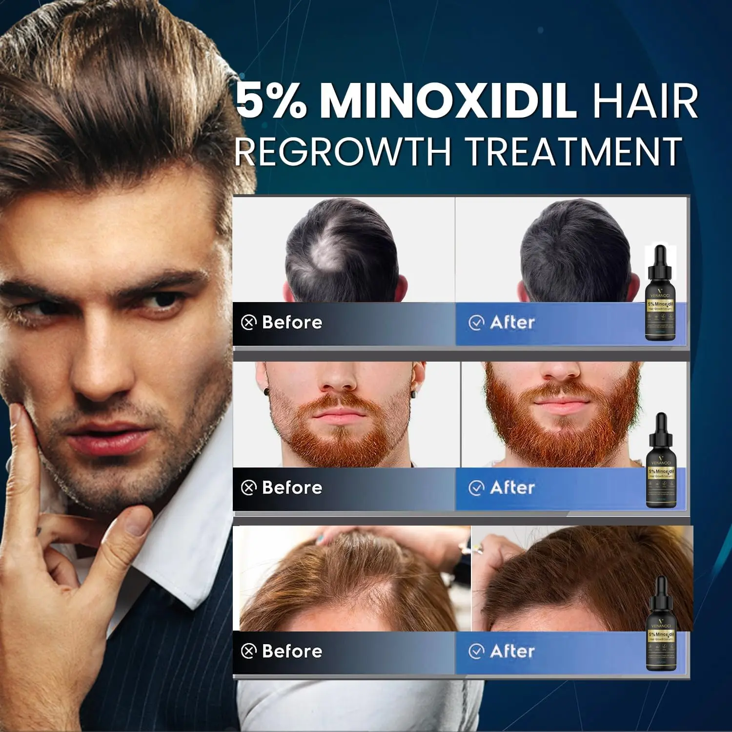 This 5% Minoxidil hair growth serum with biotin promotes hair regrowth for both men and women, offering a solution for hair loss and thinning.