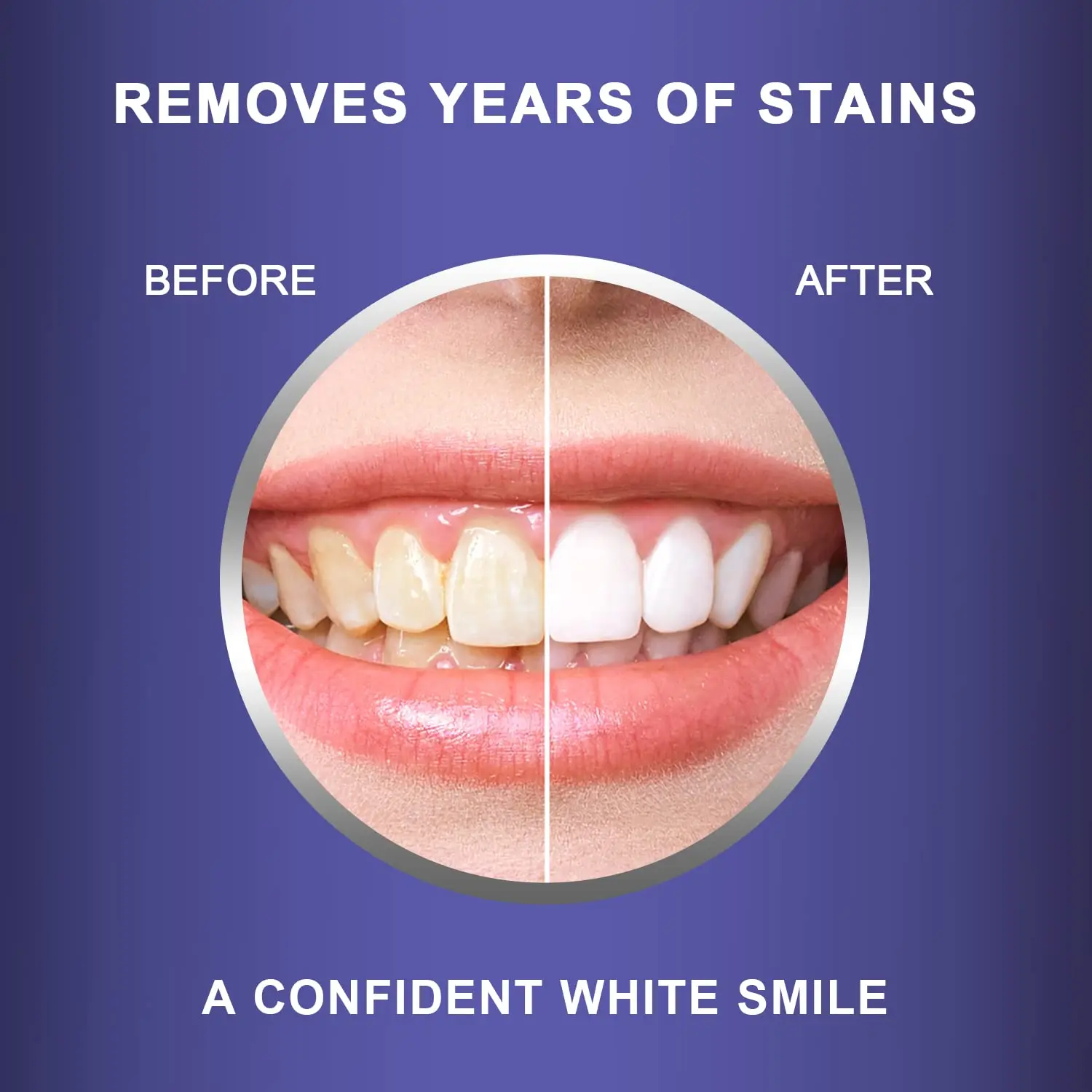 MySmile teeth whitening strips offer a gentle and effective way to brighten your smile at home, even with sensitive teeth, using a enamel-safe formula.