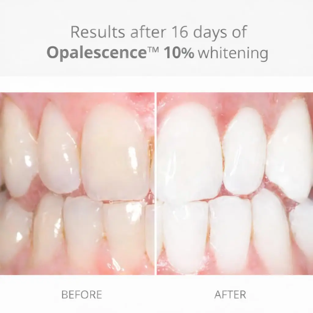 Four Opalescence PF 10% melon-flavored tooth whitening syringes from the Opalescence brand.