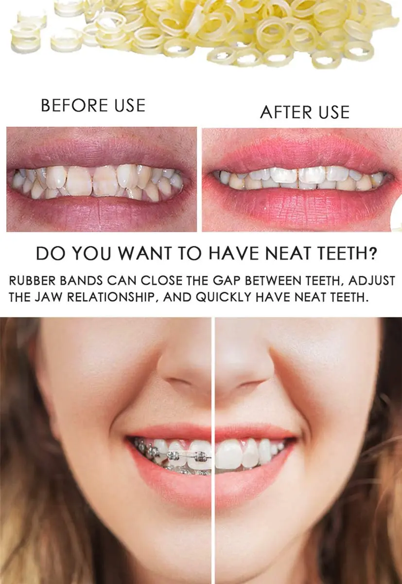 A close-up image showing a pack of 500 orthodontic elastic rubber bands designed for dental use, offering gentle and long-lasting traction with high elasticity and durability, made from safe, imported rubber materials.