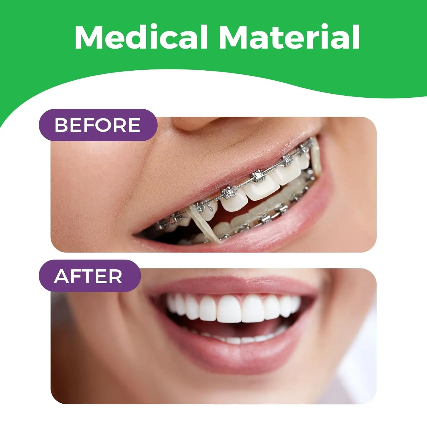 Neon 1/8 inch orthodontic rubber bands providing medium force for braces, gap closure, and various dental and creative applications, including one elastic placer.