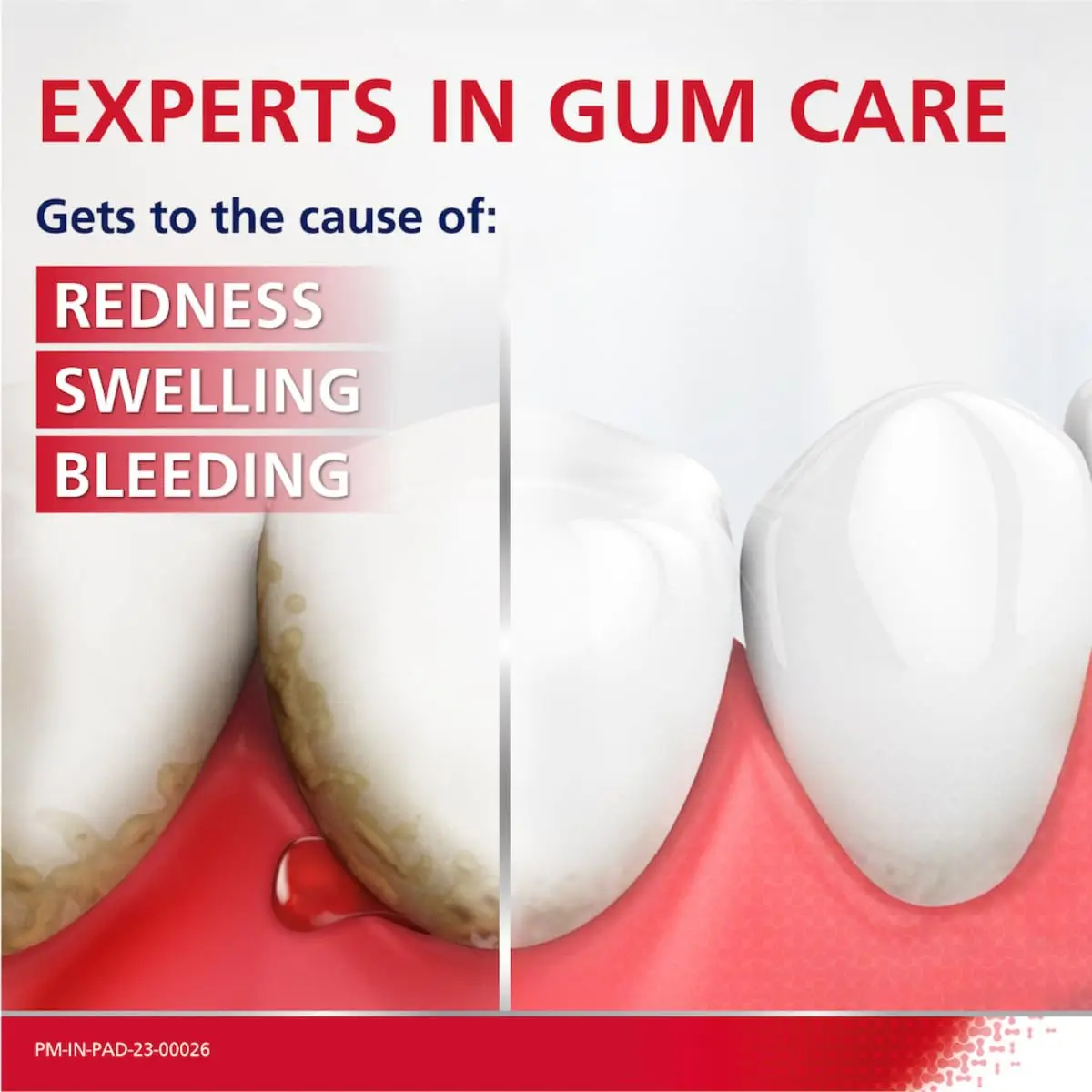 This Parodontax toothpaste is a daily fluoride treatment that helps prevent gum problems by removing plaque, reducing redness, swelling, and bleeding.