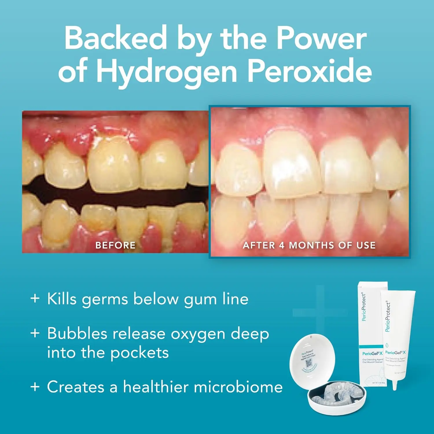 Perio Protect PerioGelX promotes teeth whitening and delivers effective, non-invasive periodontal treatment below the gum line to combat gum disease.