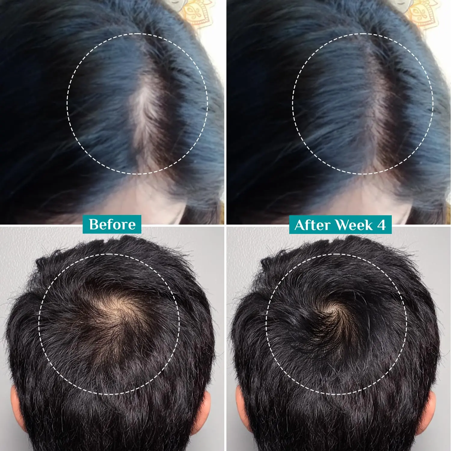 Pilgrim Redensyl hair growth serum with Anagain promotes thicker, denser, and stronger hair for all hair types and textures, addressing thinning and scalp issues.