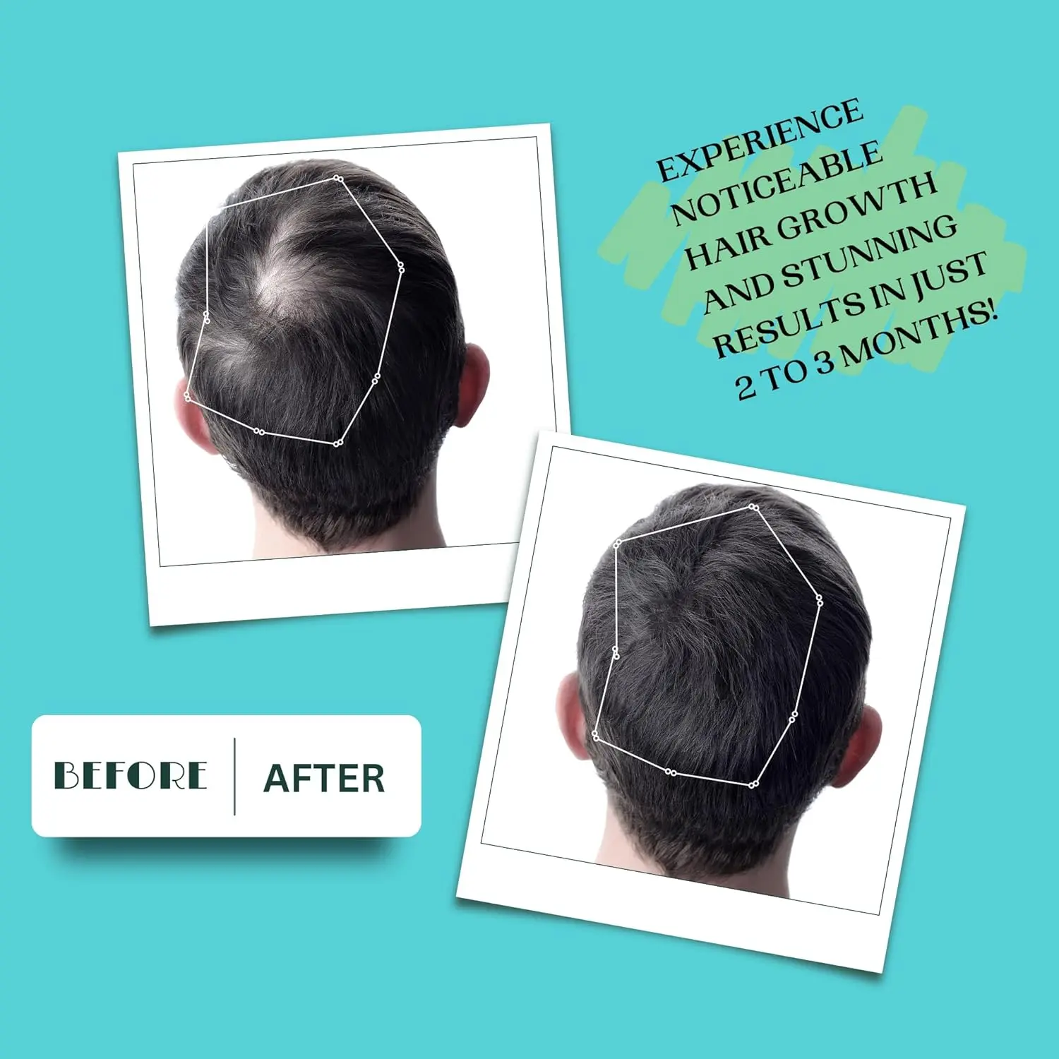 Concentrated rosemary hair treatment oil with biotin and batana helps reduce hair fall, strengthen roots and support hair regrowth for thicker, stronger hair.