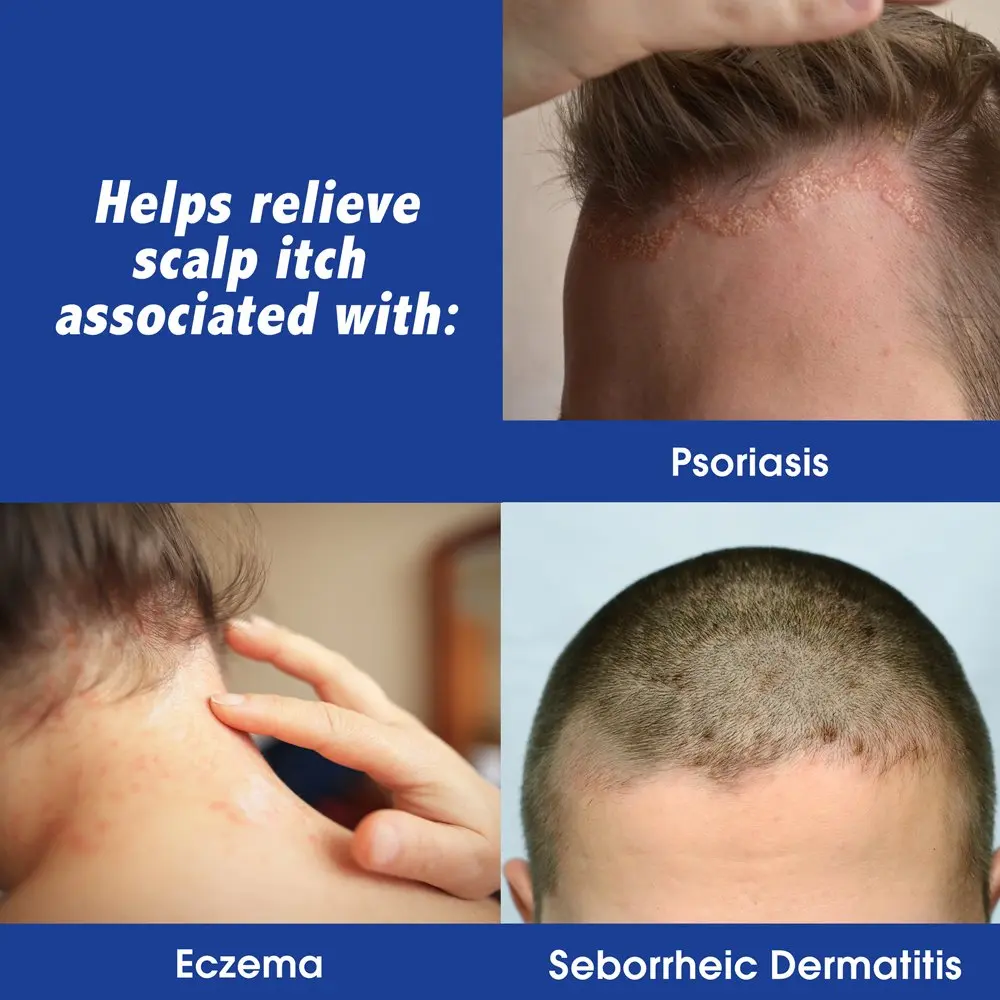 This image shows Scalpicin Maximum Strength liquid medication for relieving itchy scalp associated with psoriasis, seborrheic dermatitis, and eczema, featuring a fragrance-free and greaseless formula that improves scalp condition.