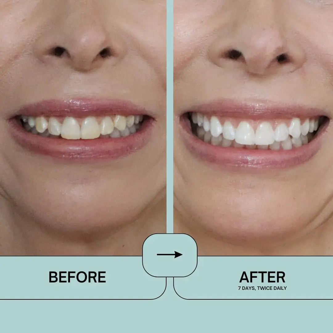 intelliWHiTE Prostrips safely whiten teeth up to 12 shades with a zero sensitivity formula that hydrates and helps mineralize enamel.