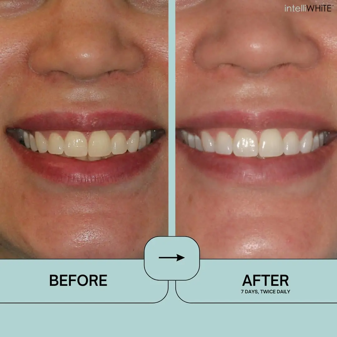 intelliWHiTE Prostrips safely whiten teeth up to 12 shades with a zero sensitivity formula that hydrates and helps mineralize enamel.