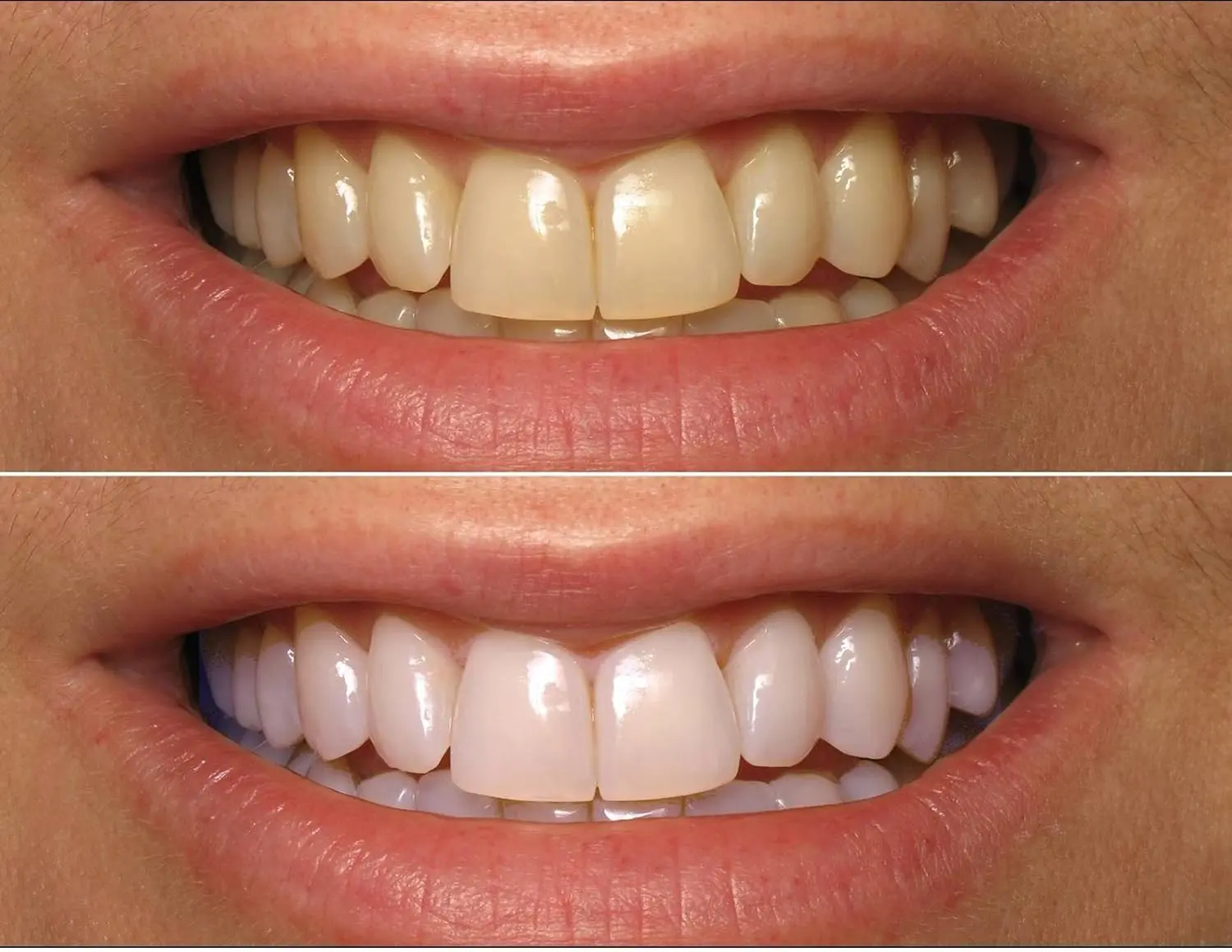 ProDental teeth whitening gel syringes with 35% carbamide peroxide safely and effectively remove years of stains from coffee, wine, and smoking, leading to a dazzling bright smile.
