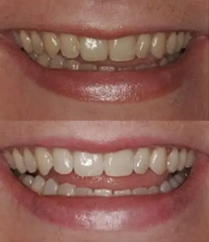 ProDental teeth whitening gel syringes with 35% carbamide peroxide safely and effectively remove years of stains from coffee, wine, and smoking, leading to a dazzling bright smile.