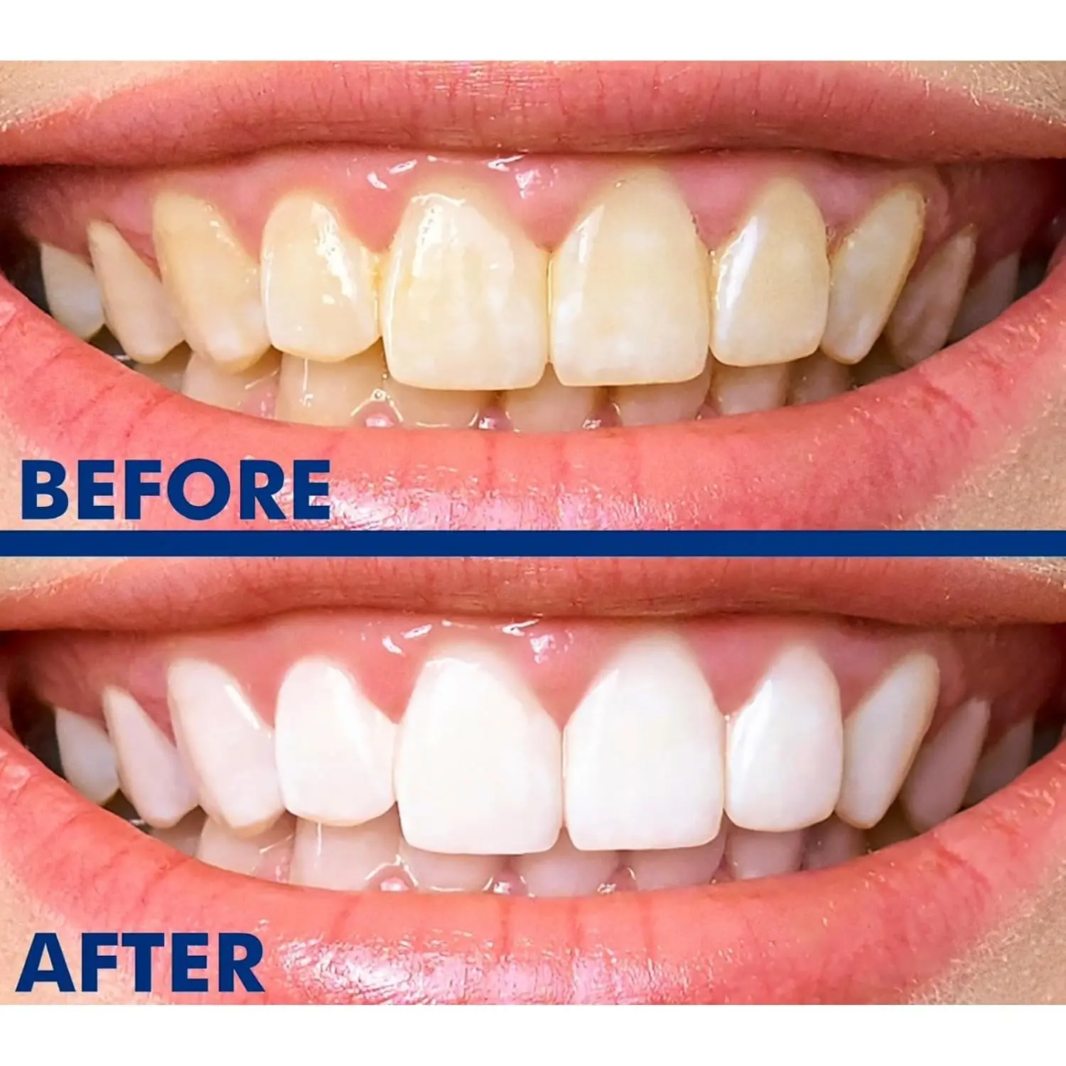 SmileWhite teeth whitening pens gently remove years of stains from coffee, wine, and more for a visibly brighter smile.