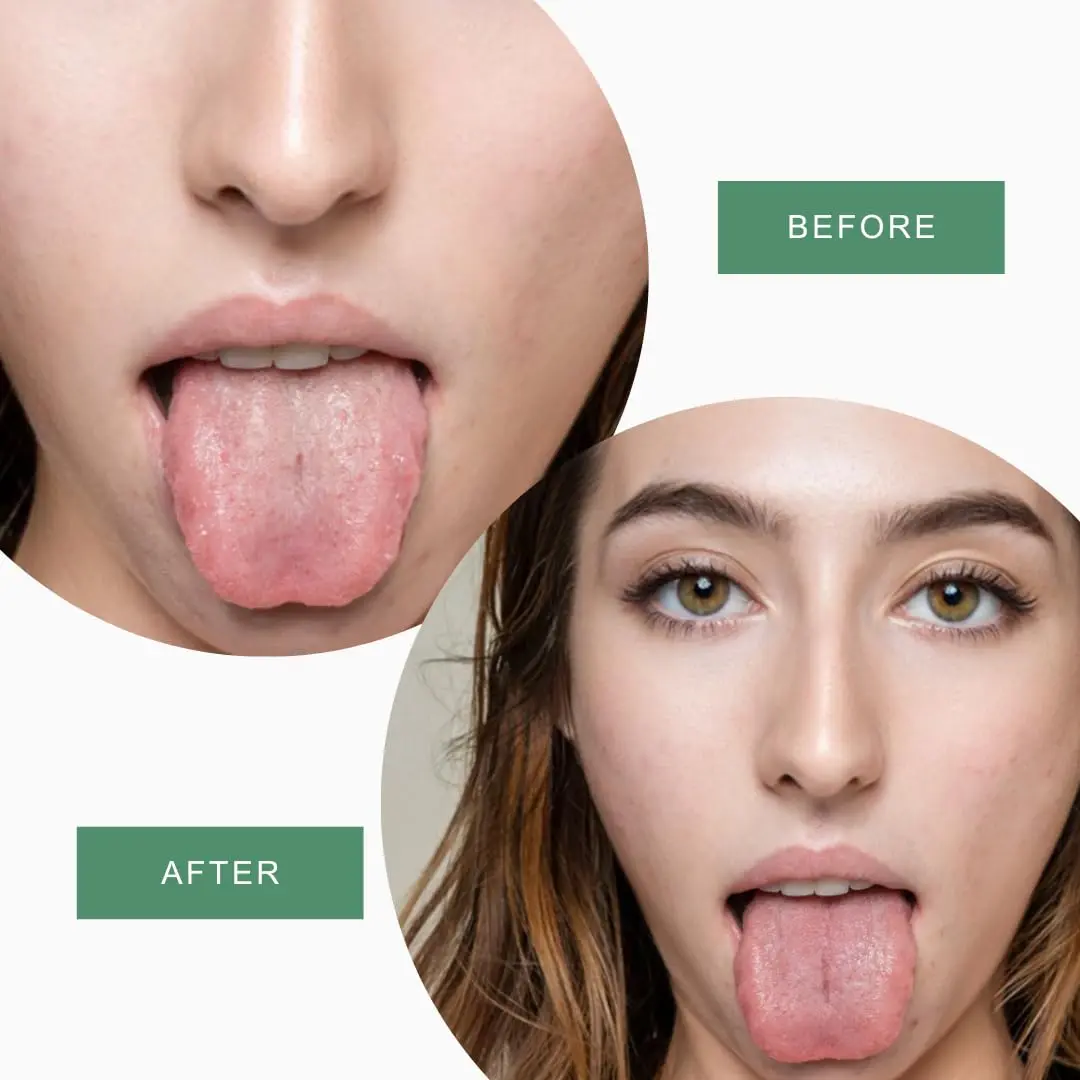 This two-pack of stainless steel tongue scrapers with travel cases helps you fight bad breath and improve oral hygiene by removing plaque and bacteria from your tongue.